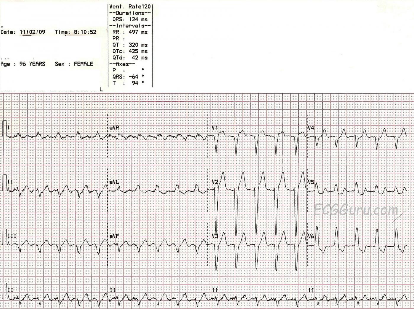 atrial-flutter-with-2-1-conduction-and-left-bundle-branch-block-ecg